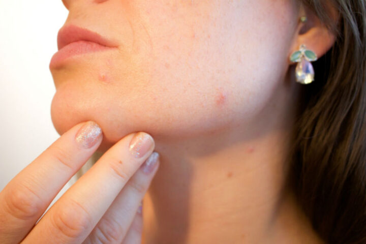 Scare Your Scars Away 5 Ways to Get Rid of Acne Scars You Likely Haven't Considered